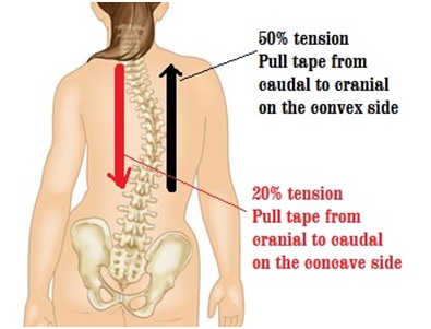 A Scoliosis Tape