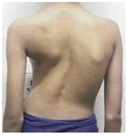 a Scoliosis